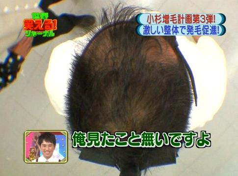 ブラマヨ小杉さんの薄毛の増毛を勝田式整体施術で行う